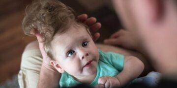 Bentley, o bebê que nasceu com o cérebro fora do crânio e sobreviveu; Ele passou por cirurgia inédita