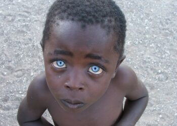 Doença faz crianças negras nascerem com incríveis olhos azuis safira