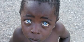 Doença faz crianças negras nascerem com incríveis olhos azuis safira